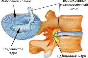 4 Рецепту компресів з кінським жиром для лікування грижі