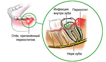 Що таке періостит щелепи симптоми і лікування періоститу