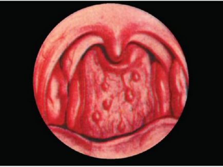 Що таке хронічний гранулезнимі фарингіт причини появи лімфоїдних гранул і симптоми, лікування