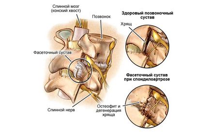 Деформуючий спондильоз поперекового відділу хребта, його симптоми і лікування