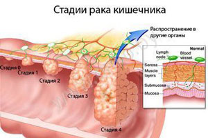 Фотографії раку кишечника