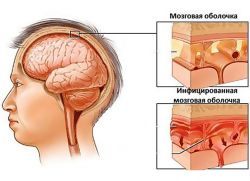 гнійний менінгіт