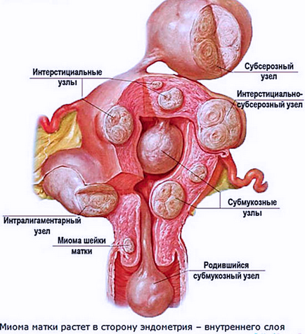 Міома матки лікування народними засобами, діагностика та рекомендації