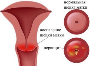 Молочниця перед місячними причини і лікування