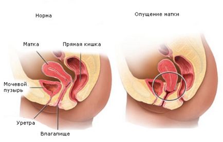 Опущення задньої або передньої стінки матки в чому небезпека для жінки