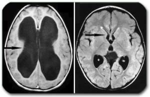 Відкрита гідроцефалія симптоми, лікування