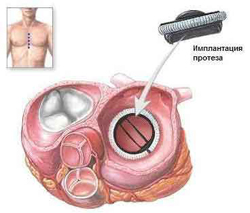 Протезування клапана серця