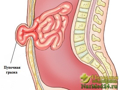 Пупкова грижа у дорослих і дітей перші симптоми, комплекс профілактичної допомоги