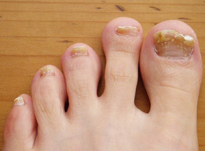 nail fungush lábak kezelése cipő feldolgozás)
