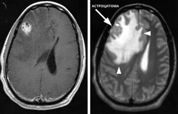 Brain Astrocytoma - mi ez, milyen veszélyes viseli tumor