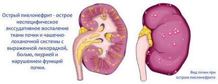 Болять нирки симптоми, ніж лікувати, що робити і в домашніх умовах