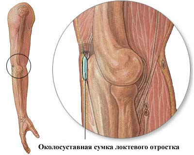 Бурсит причини, симптоми, лікування