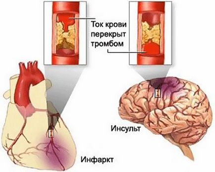 Чим відрізняється інсульт від інфаркту в чому різниця, ознаки, відмінності