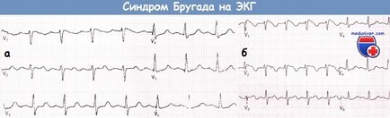 EKG Brugada szindróma és annak kezelése