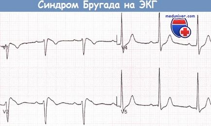 Sindromul ECG Brugada si tratamentul acesteia