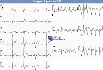 Sindromul ECG Brugada si tratamentul acesteia