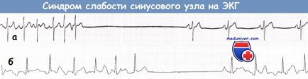 ECG cu sindrom de sinus bolnav (SSS)