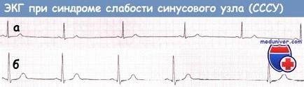 EKG sick sinus szindróma (SSS)