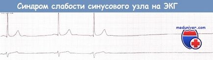 EKG sick sinus szindróma (SSS)