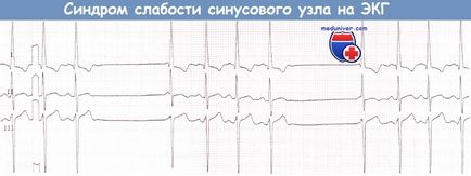 ECG cu sindrom de sinus bolnav (SSS)