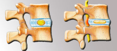 Екструзія дисків хребта що це таке