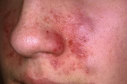 eczeme simptome, semne, cauze si tratament (foto și video)