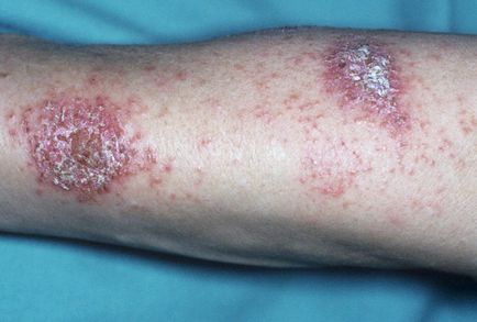 eczeme simptome, semne, cauze si tratament (foto și video)