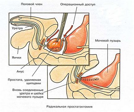 Фіброз передміхурової залози - ще не вирок, але дуже серйозне попередження