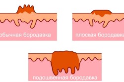 Як вивести бородавки народними засобами