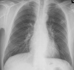carcinom pulmonar cu celule scuamoase, celule mici, prognoza de grad scazut