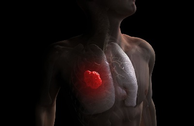 Carcinom pulmonar prognosticul de supravietuire, simptome și tratament