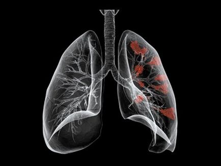 Carcinom pulmonar prognosticul de supravietuire, simptome și tratament