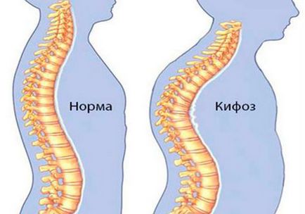 Кіфоз шийного відділу хребта - що це, симптоми і лікування