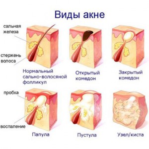 Корейські маски і патчі від чорних крапок відгук, фото до і після, - жіночий блог про красу і здоров'я