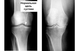 Лікування всіх форм артрозу в китаї