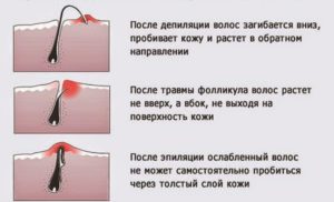 Лосьйон аравия від врослого волосся відгуки та рекомендації