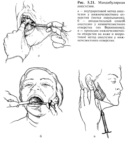 Мандибулярна анестезія - хороший стоматологічний портал, хороший стоматологічний портал