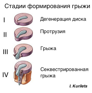 Міжхребцева грижа, остеохондроз, лікування міжхребцевої грижі, міжнародний центр нейрохірургії