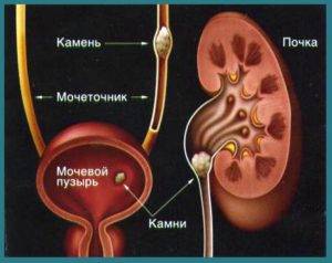 Сечокам'яна хвороба у чоловіків, профілактика сечокам'яної хвороби