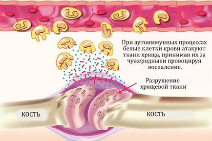 Недиференційований артрит, що це таке лікування