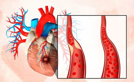 Akut miokardiális infarktus subendocardialis okait és a fejlesztés a tünetek