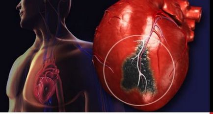 Akut miokardiális infarktus subendocardialis okait és a fejlesztés a tünetek