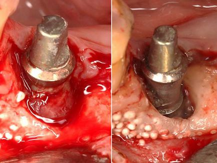 Періімплантіт причини, симптоми, фото, лікування