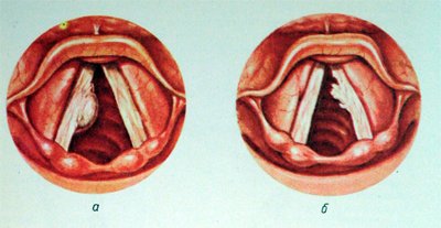 Care sunt cauzele simptome si tratamente ale bolii principale laringian papiloma