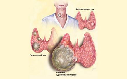 Ознаки раку щитовидної залози