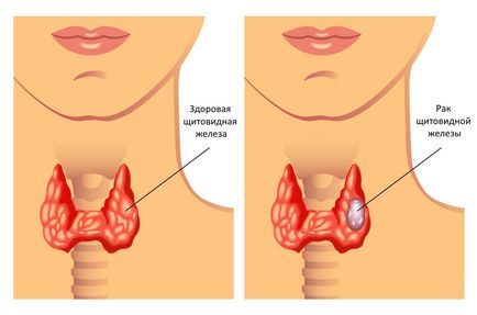 Ознаки раку щитовидної залози