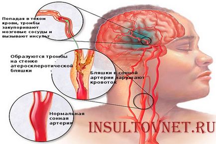 Блювота при інсульті причини, допомога і відновлення