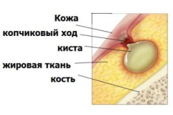 Свищ на п'ятій точці причини, симптоми, лікування і ускладнення