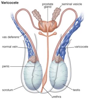 Варикоцеле у підлітків і чоловіків причини, симптоми, лікування
