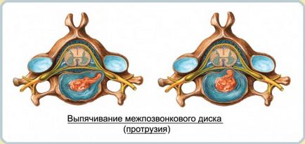Все про грижіекструзія міжхребцевих дисків і її види